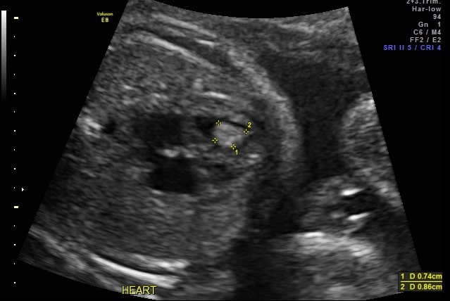prenatal scan 2